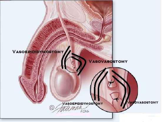 Vasovasectomy 