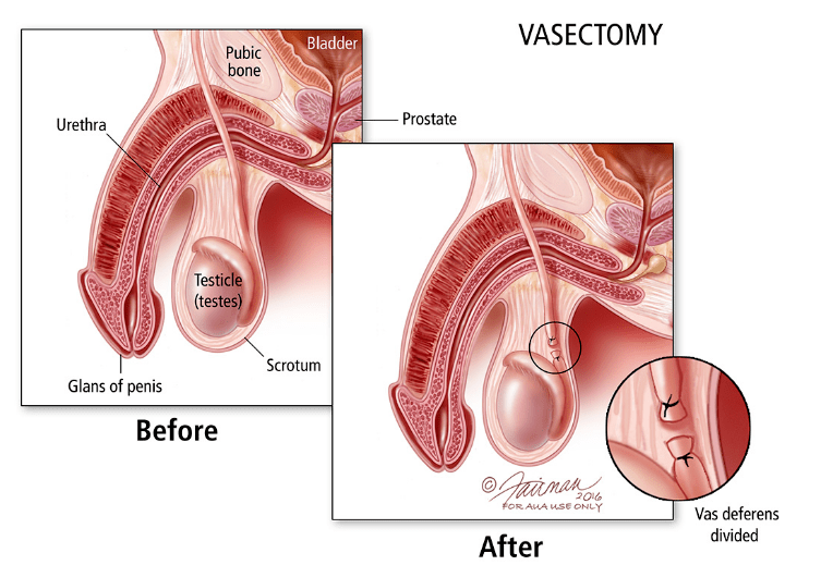 Vasectomy before and after